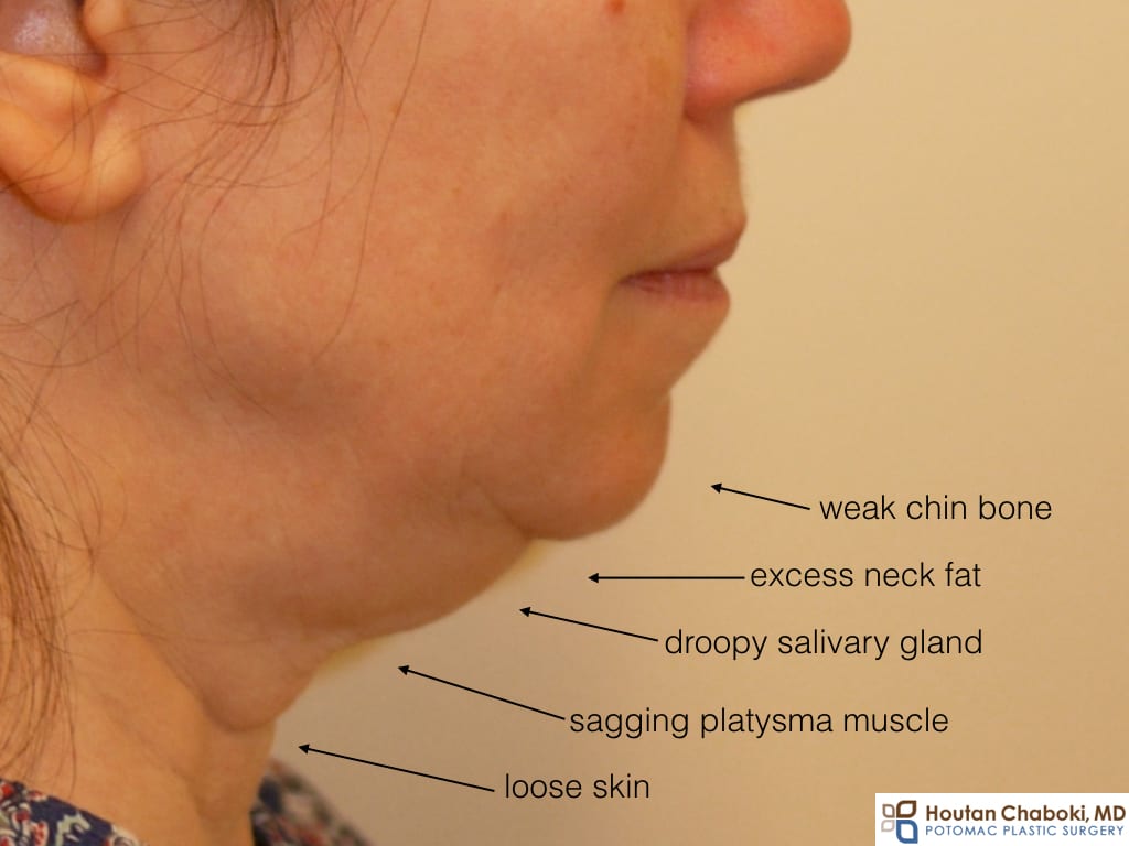 Treating a double chin or submental fullness: Liposuction, Chin implant