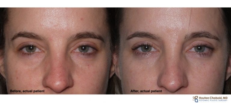 A lower eyelid lift without surgery – Potomac Plastic Surgery