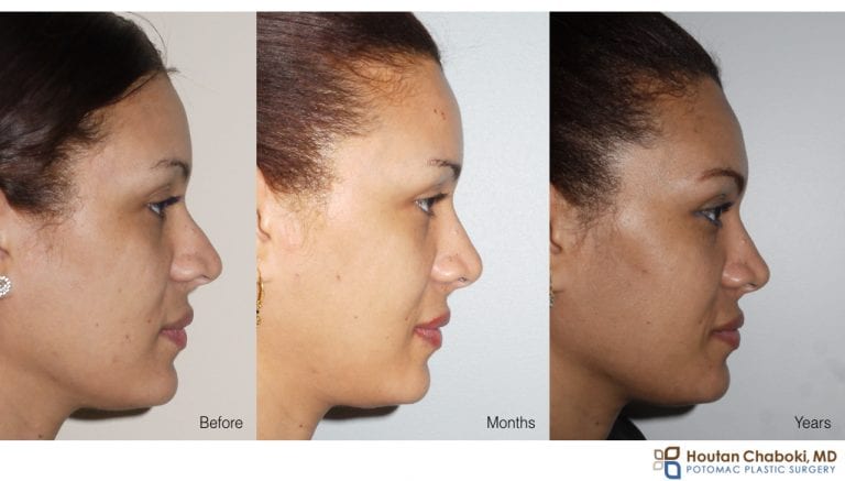 How to reduce swelling after rhinoplasty