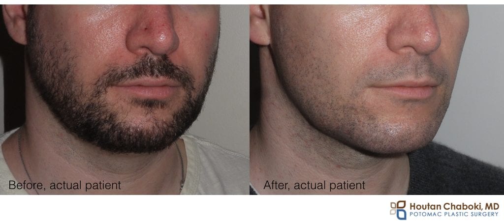 Large Nose And Small Chin In A Rhinoplasty Patient Potomac Plastic 