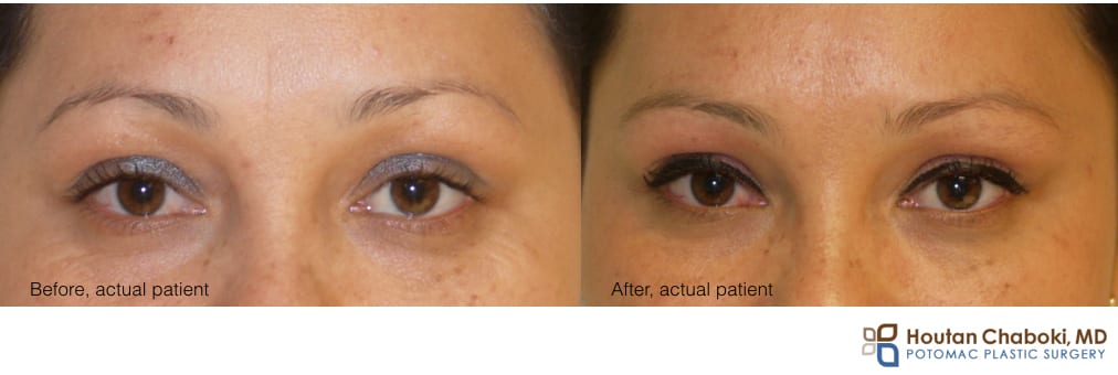 Can Starting Botox/Dysport Treatment Early Prevent Wrinkles?