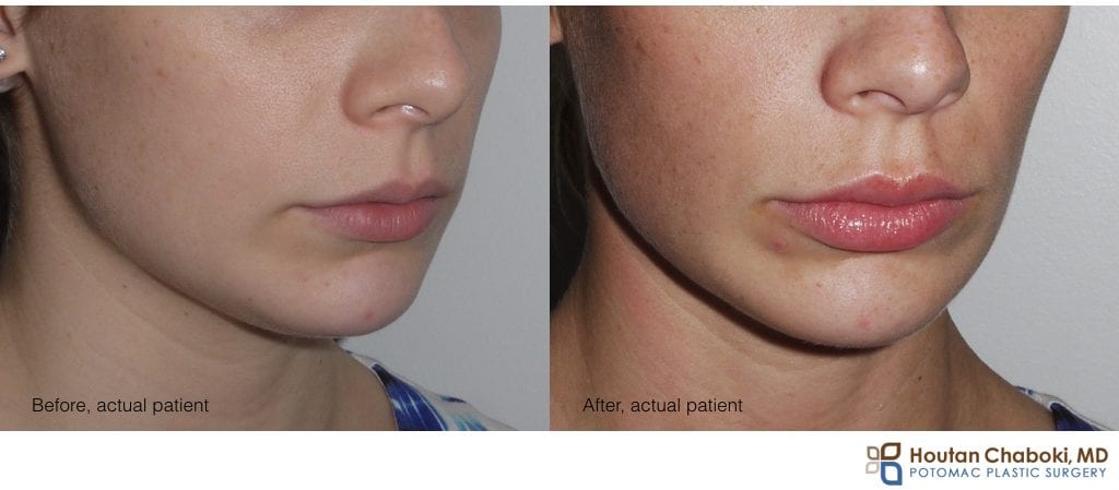 Blog Post Before After Lip Injection Hyaluronic Acid Juvederm Woman.001 1024x449 