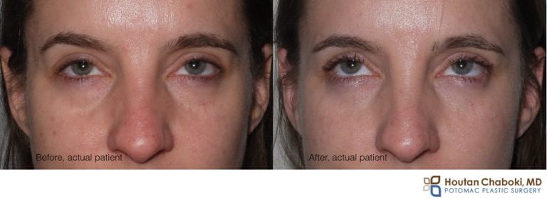 Puffy Lower Eyelids are not always from Fat