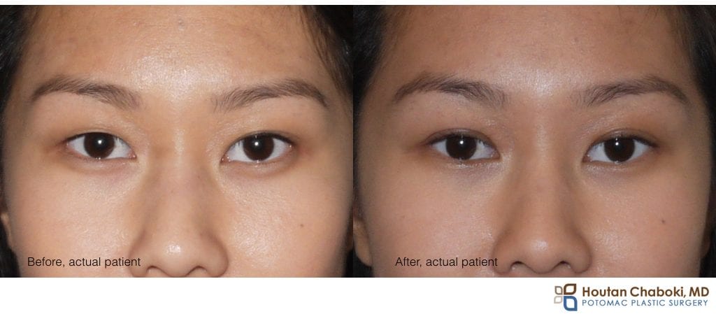 double fold with upper eyelid surgery