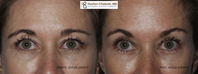 Nonsurgical Brow Lift with Botox or Dysport