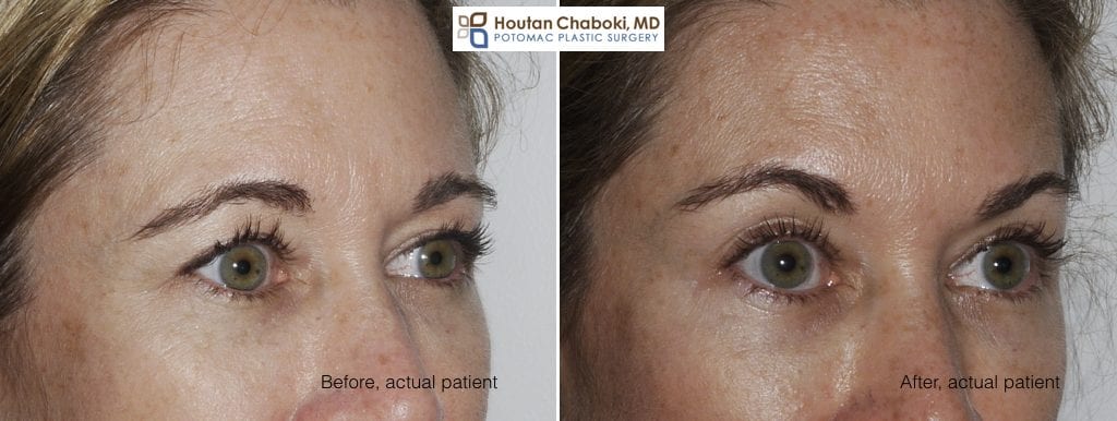 Nonsurgical Brow Lift With Botox Or Dysport