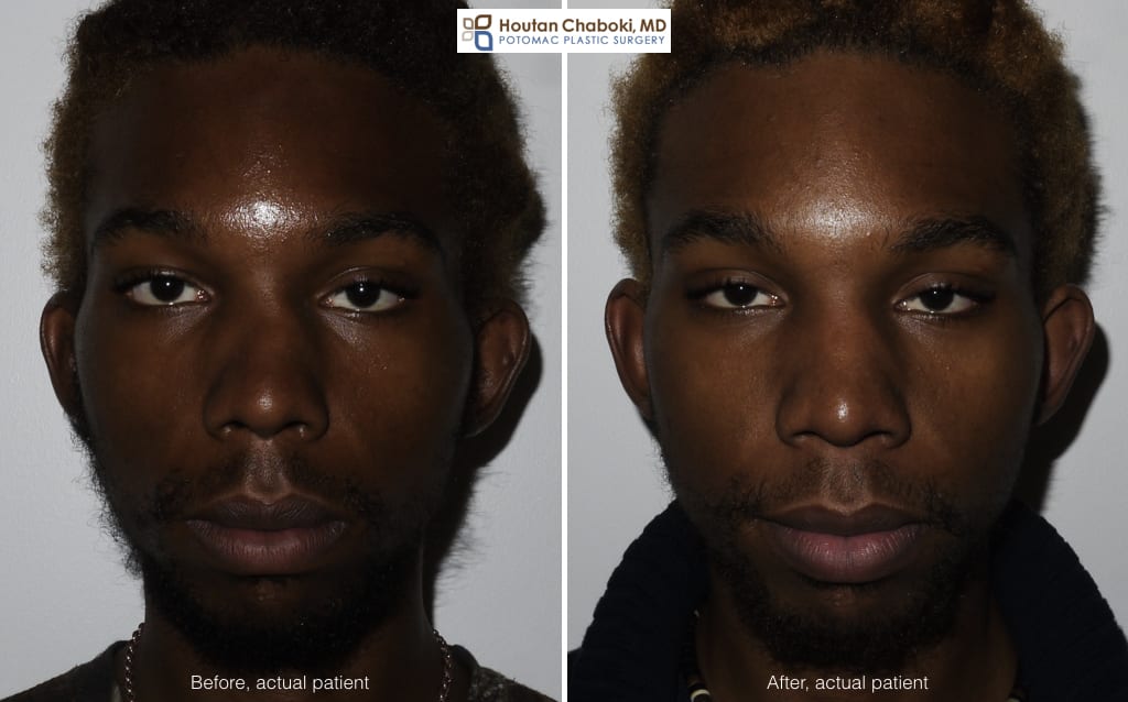 crooked nose before and after