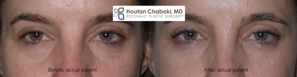 Eyebags Removal Surgery | Blepharoplasty in Orange County, CA