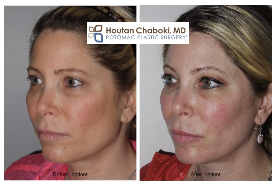 juvederm cheeks before and after photos