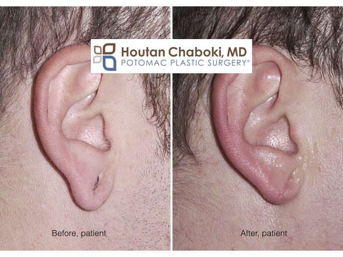 Burt and Will Plastic Surgery and Dermatology   Patients contact us for  earlobe reconstruction for a variety of reasonsWhether it is for  repairing split ears from wearing heavy earrings stretched earlobes