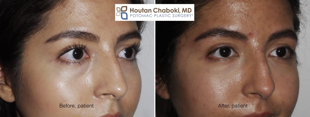 Immediate Results- Goodbye Under Eye Circles | Fort Lauderdale | Dr. Todd  Sawisch