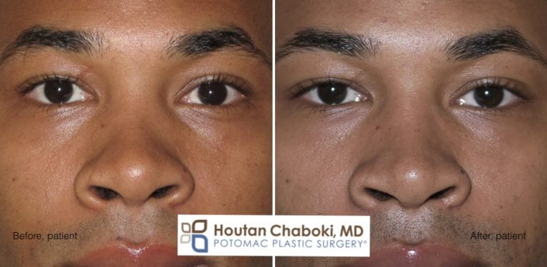 Augmentation Rhinoplasty Without Breaking The Nose