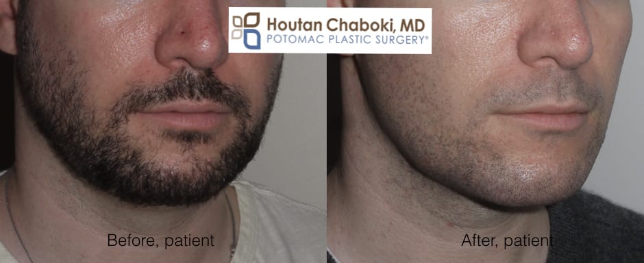 Get a Chiseled Face With Facial Liposuction