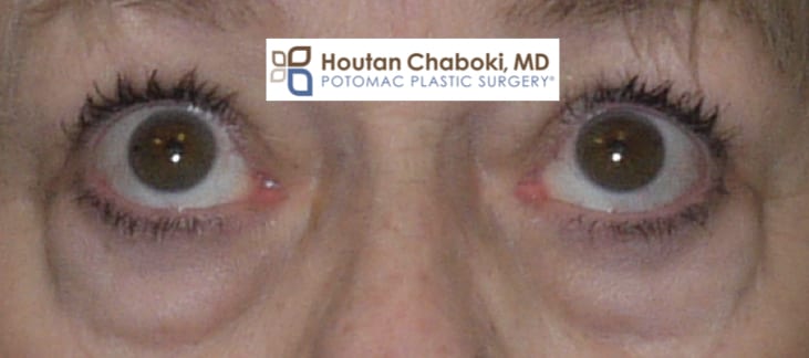 Rejuvenate Your Eyes: Dr. Bennett's 13 tips to cure dark circles and puffy  eyes | Norelle Health