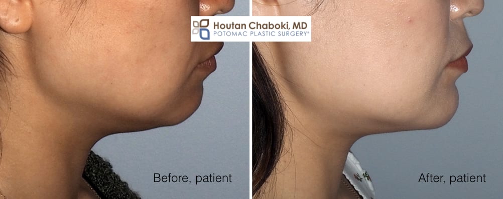 Blog Post Before After Chin Surgery Augmentation Implant Neck Lift Liposuction Facelift.001 