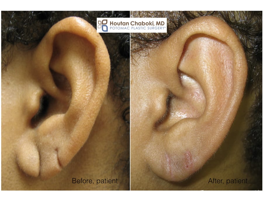What is earlobe repair?  American Society of Plastic Surgeons
