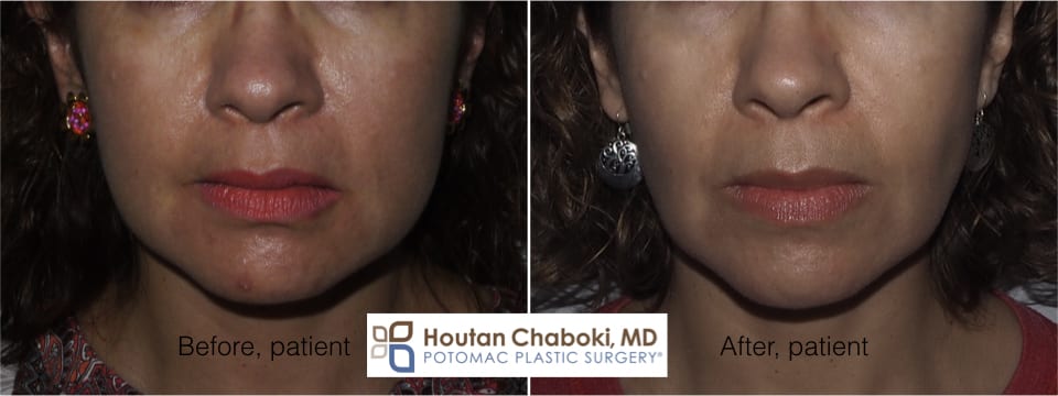 Contouring Cheeks with Fat Reduction
