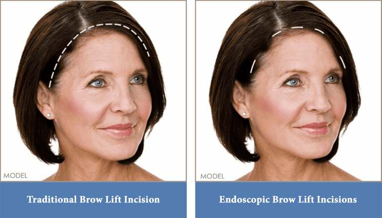 Brow (Forehead) Lift Washington, DC, & Arlington, VA | Potomac Plastic ...