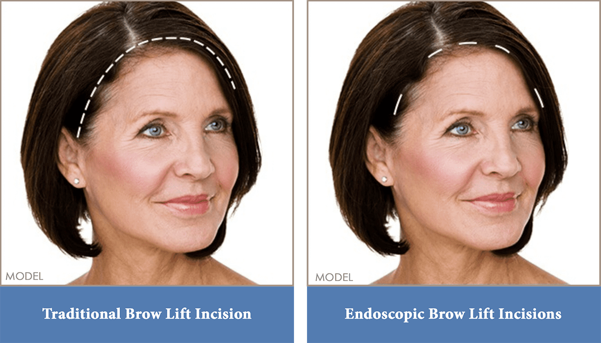 Brow (Forehead) Lift Washington, DC, & Arlington, VA | Potomac Plastic ...