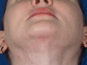 https://www.potomacplasticsurgery.com/content/uploads/2022/11/Deep-neck-lift-scar-under-chin-300x225.jpg